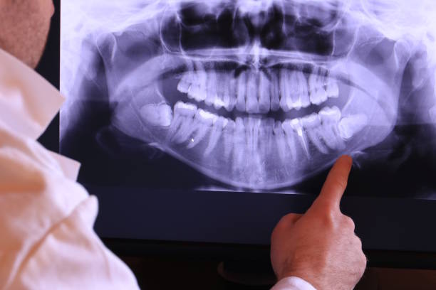 Best Emergency Dental Extractions in Hemphill, TX